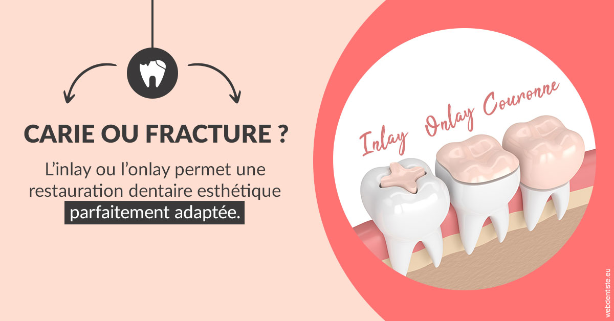 https://dr-dada-karim.chirurgiens-dentistes.fr/T2 2023 - Carie ou fracture 2