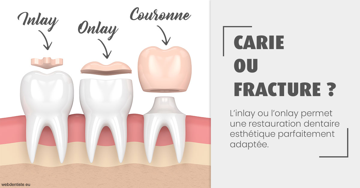 https://dr-dada-karim.chirurgiens-dentistes.fr/T2 2023 - Carie ou fracture 1