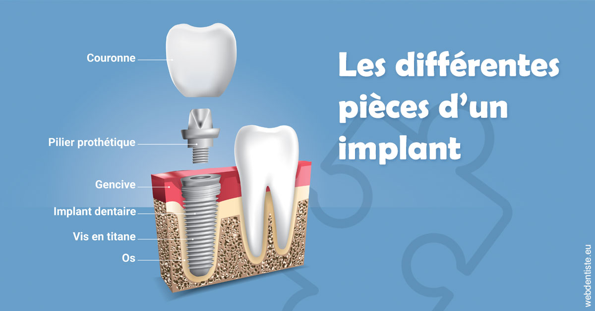 https://dr-dada-karim.chirurgiens-dentistes.fr/Les différentes pièces d’un implant 1