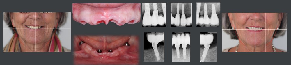 Réhabilitations esthétiques complexes par implants dentaires