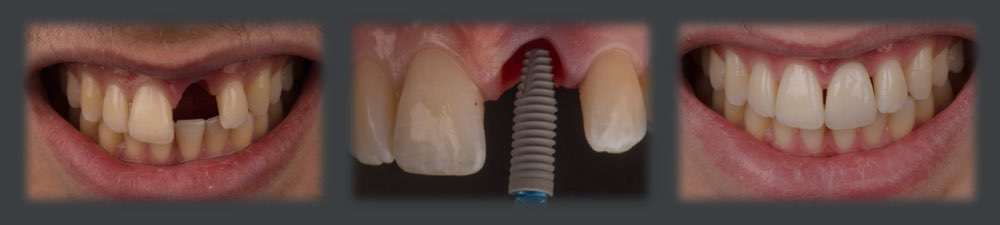 Remplacement immédiat d'une dent antérieure par un implant dentaire