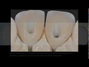 Greffe osseuse, implants dentaires et couronnes céramo-céramiques au niveau de deux incisives centrales
