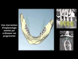 Remplacement de toutes les dents postérieures par des implants dentaires