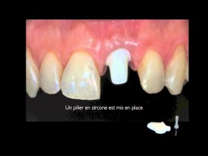 Implant dentaire/Dental implant: incisive centrale