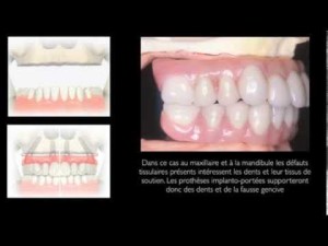 Implants dentaire/Dental Implants : Transplantation