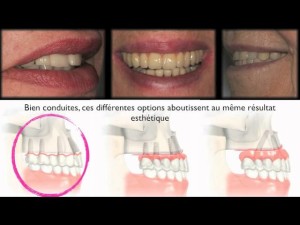 Implaants dentaires/dental implants : Edentation