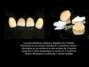 Transformation du sourire en cas d'agénésie: implants dentaires, facettes et couronnes céramo-céramiques
